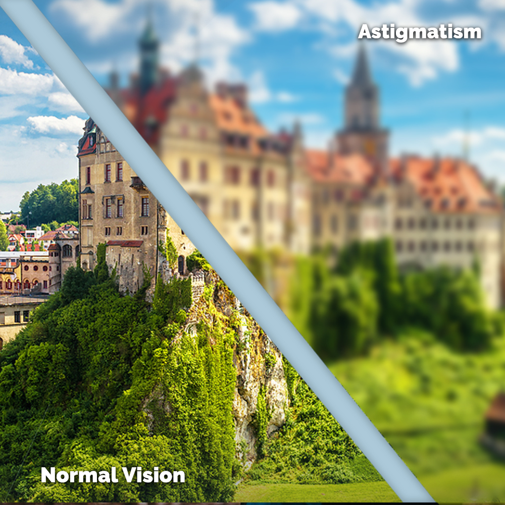 Astigmatism Treatment in South Denver
